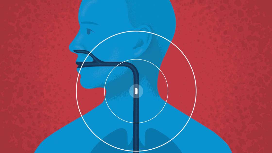 An animated image showing an oesophagus inside a human head/neck with the infliximab capsule being swallowed. An animated image showing an oesophagus inside a human head/neck with the infliximab capsule being swallowed.